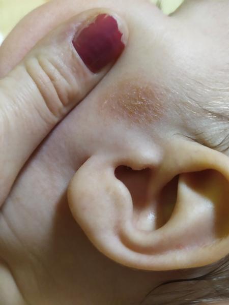 Kožní ekzém, kvasinka nebo plíseň. Co by to mohlo být?