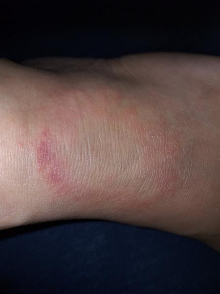 Červený flek na nártu. Borelióza, mykóza nebo něco jiného?