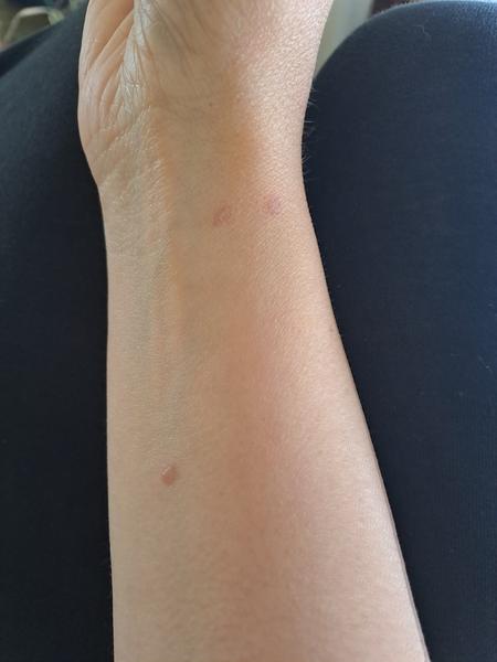 Vyrážka na ruce a krku. Může to souviset s těhotenstvím?