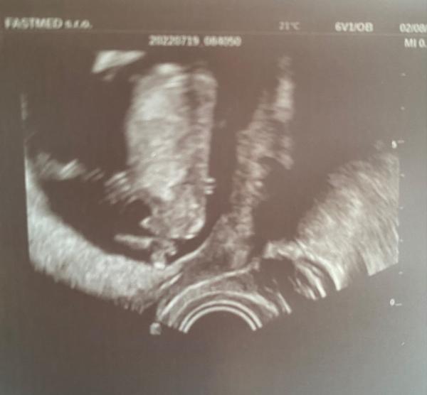 Jak určit pohlaví dítěte z ultrazvuku?