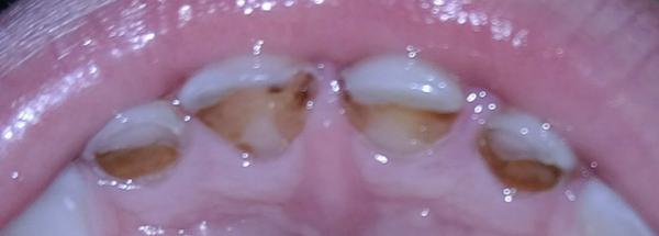 Horní řezáky u 4letého ditěte. Můžou podle Vás ještě vydržet?