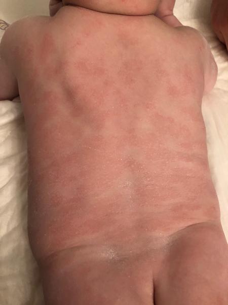 Ekzém nebo kvasinka. Jak a čím pokračovat v léčbě?