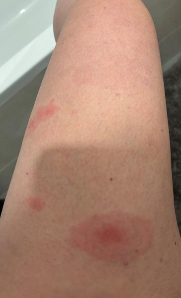 Může se jednat o svrab, nebo je to něco jiného?