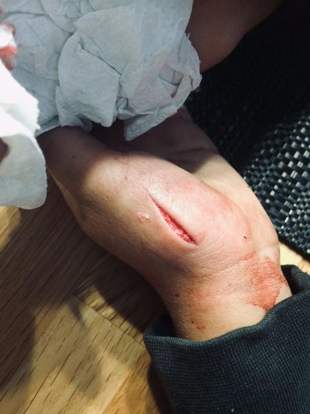 Je nutné řešit tržnou ránu den po úrazu?