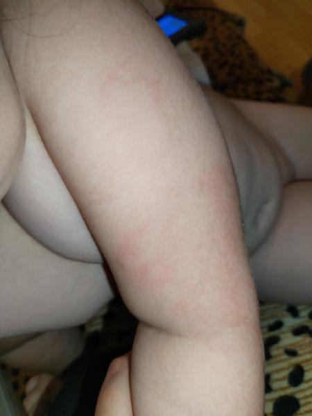 Kožní alergie nebo štípance? Zkušenosti s neobvyklými projevy na kůži.