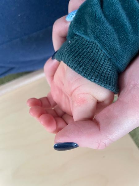 Jak řešit vyrážku u dítěte, pokud mast nepomáhá?