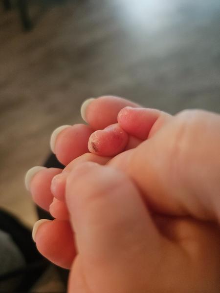 Popraskaná kůže na prstech u batolete. Co pomáhá?