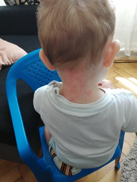 Jak poznat příčinu vyrážky u ročního miminka?