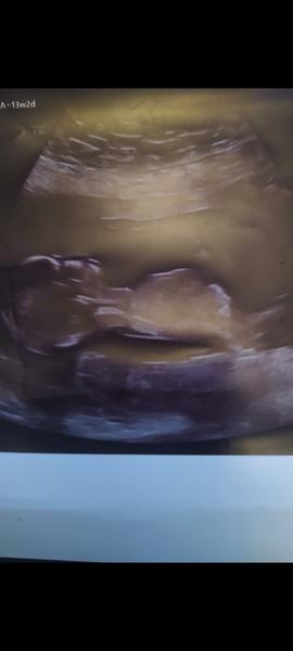 Poznáte pohlaví miminka z ultrazvukové fotky?