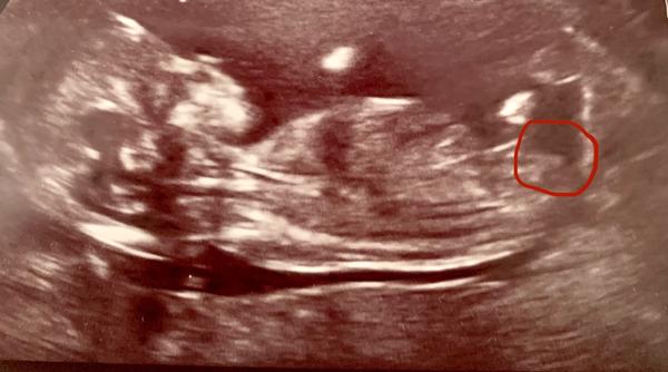 Pohlavní hrbolek na ultrazvuku. Jak ho poznat?