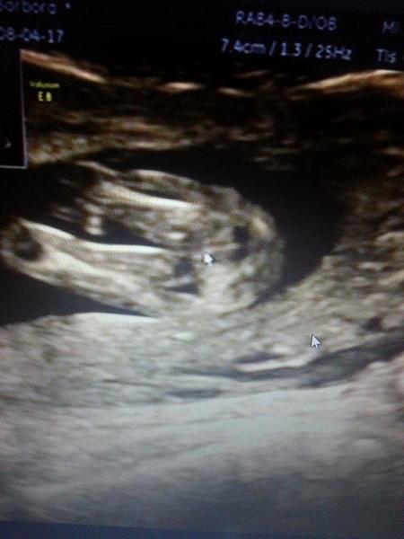 Poznáte pohlaví ve 14. týdnu těhotenství?