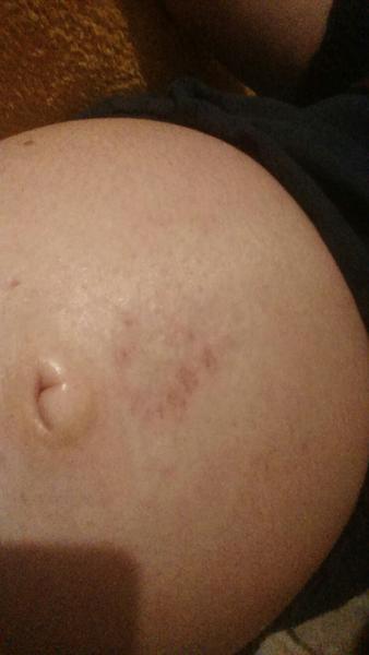 Vzhled bříška v těhotenství. Nemůže svědění ublížit mimískovi?