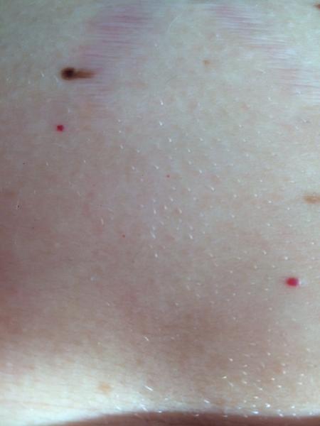 Červená znaménka mezi prsy a nad pupíkem. Je to normální?