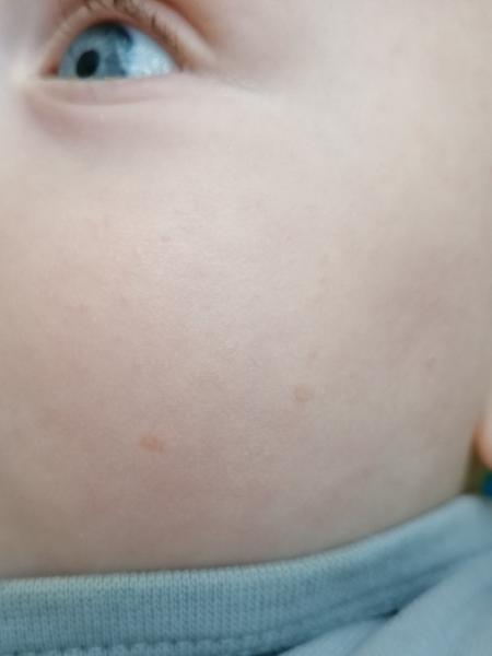 Pupínky na tvářičkách. Neměl někdo něco podobného?