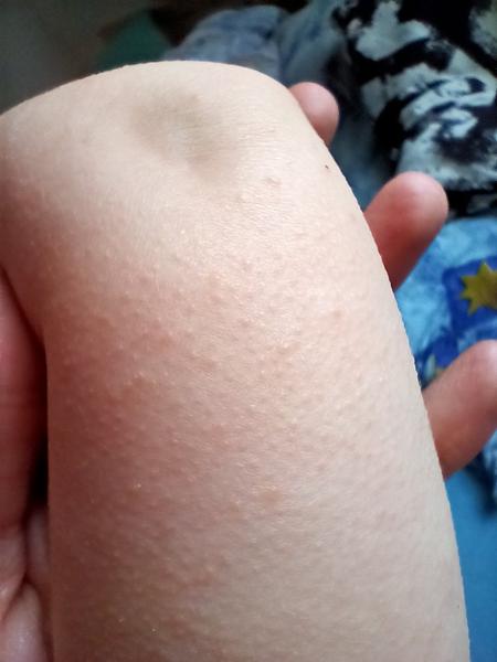 Vyrážka na obličeji a krupička po těle. Co si o tom myslíte?