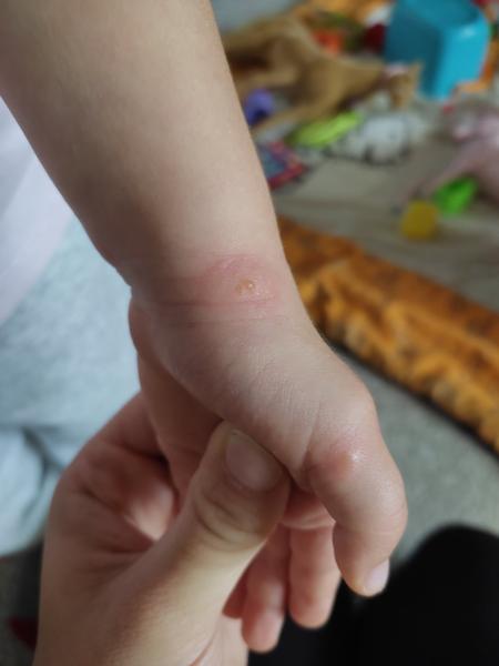 Jsou to neštovice? Jak poznat příznaky u dětí?