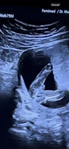 Holčička nebo chlapeček?