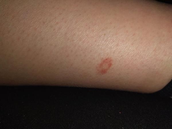 Vyrážka bez svědění. Co to může být?