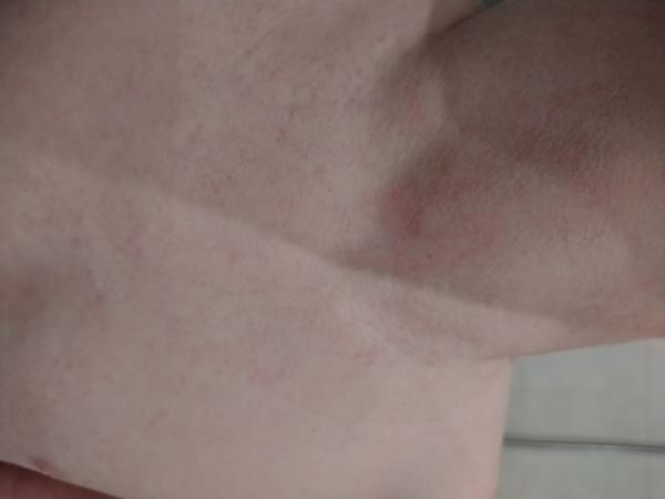 Vyrážka. Nevíte, co by to mohlo být?