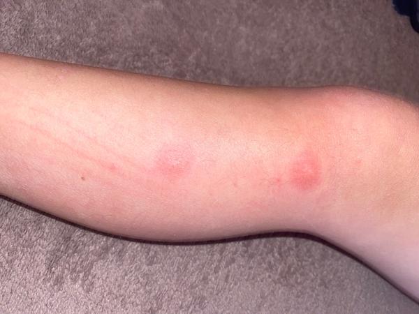 Je to vyrážka? Co značí skvrny na kůži dětí?