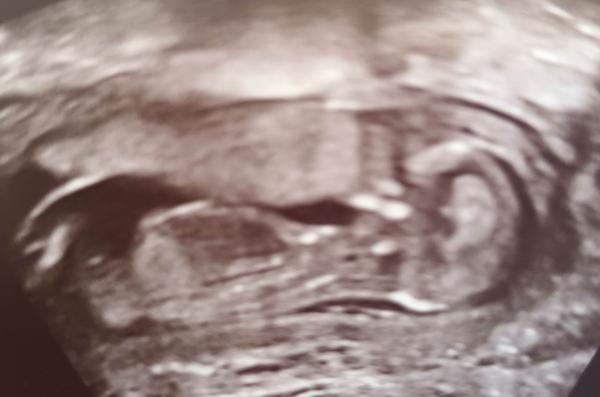 Jak určit pohlaví z ultrazvukové fotky ve 14. týdnu?