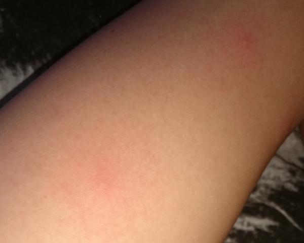 Záhadné pupínky. Co by to mohlo být?