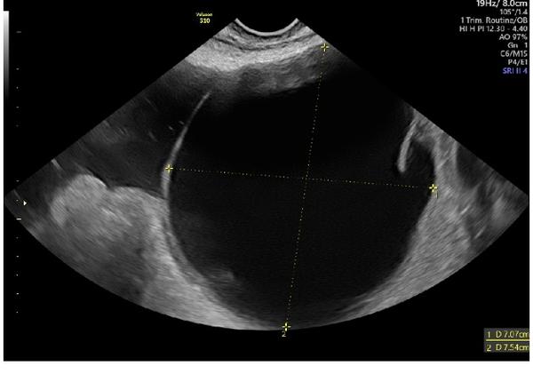 Čtení na ultrazvuku. Co mohu vidět?