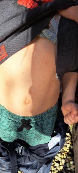 Možné příčiny svědivé vyrážky u dvouletého dítěte