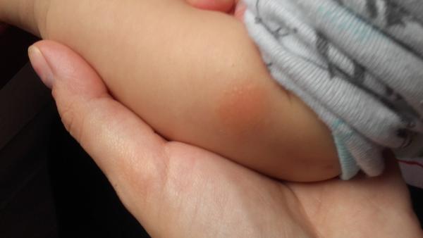 Suché červené flíčky, co to může být?