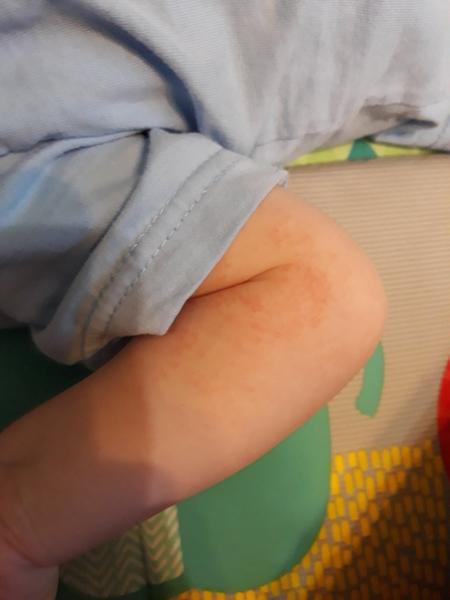 Atopický ekzém u dětí. Objevuje se a mizí. Typická místa pro ekzém jsou ale vždy čistá.