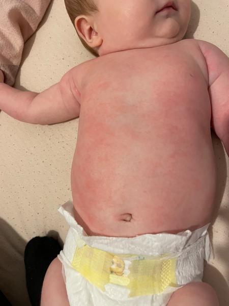 Ekzém nebo kvasinka?