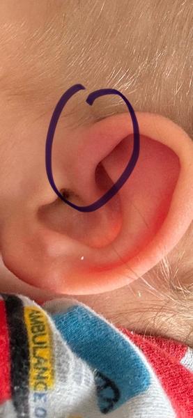 Příznaky boreliózy u dítěte po kousnutí klíštětem. Co dělat?