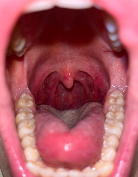 Bílé patro a slabost. Ucpané slinné žlázy?