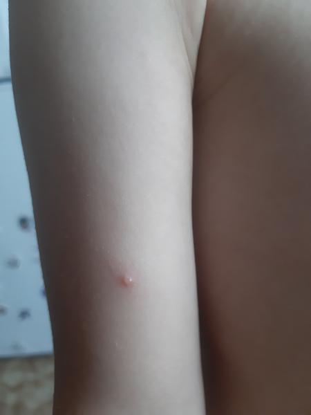 Mohou pouze pupínky u dcery znamenat neštovice?