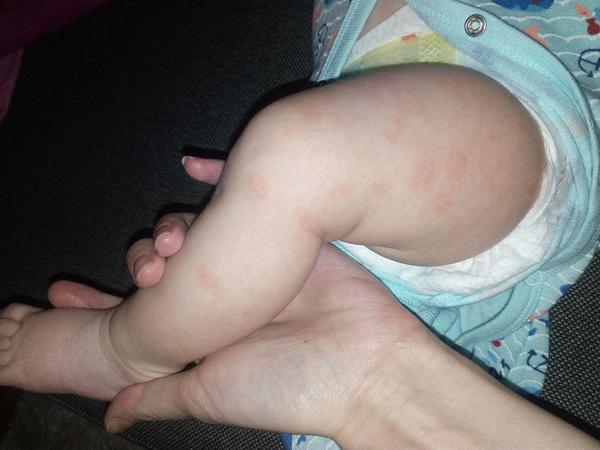 Je toto atopický exém?