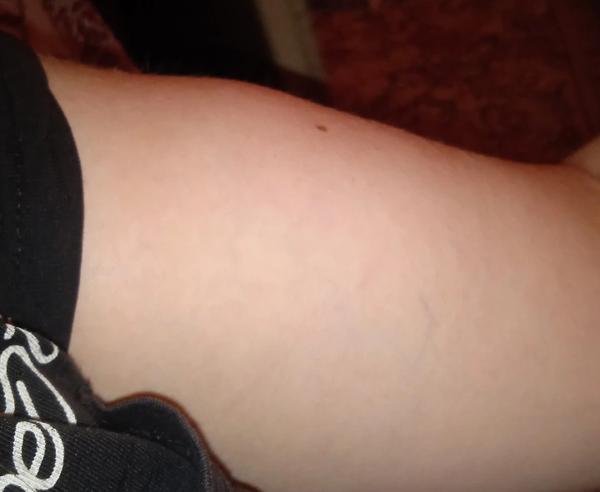 Opuch a bolest ruky bez diagnózy. Máte zkušenosti?