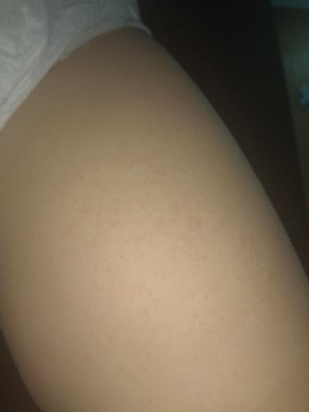 Vyrážka - krupička u dvouletého syna