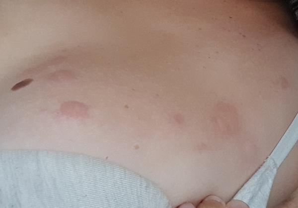 Svědivé pupínky po těle: Jaké jsou možné příčiny?