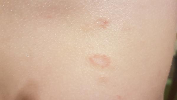 Jak rozpoznat vyrážku u dítěte? Pomoc rodičům.