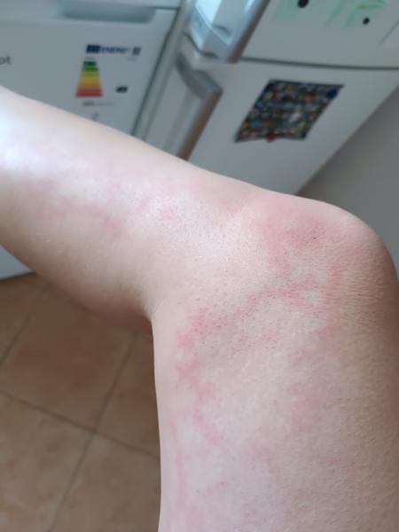 Příčiny vyrážky na noze. Co ji způsobuje?