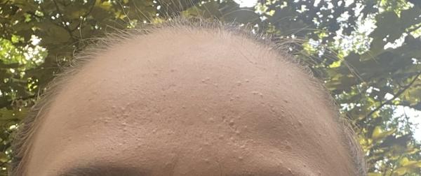 Zaručené produkty na akné? Prosím, pomozte mi už se toho zbavit. 😔