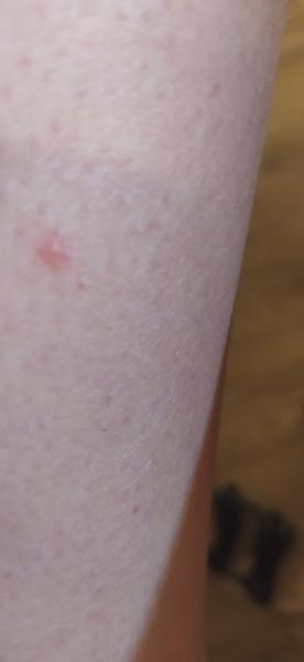 Je svědivý pupínek na noze příznakem něčeho vážného?