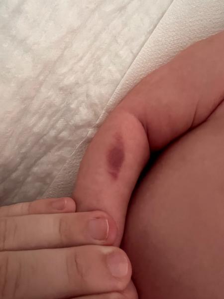 Může se jednat o modřinu?