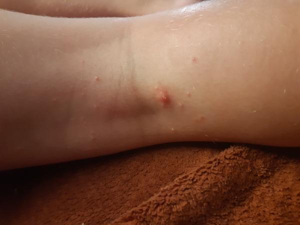 Pupínky na noze u dcery. Co to může být?