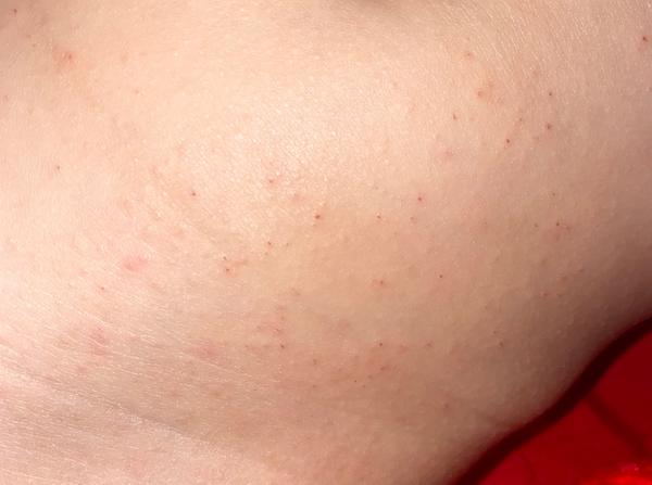 Kožní vyrážka. Co by to mohlo být?