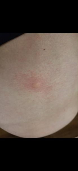 Štípanec nad zadkem: Co to mohlo způsobit?