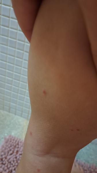 Co způsobuje vyrážku na noze syna?