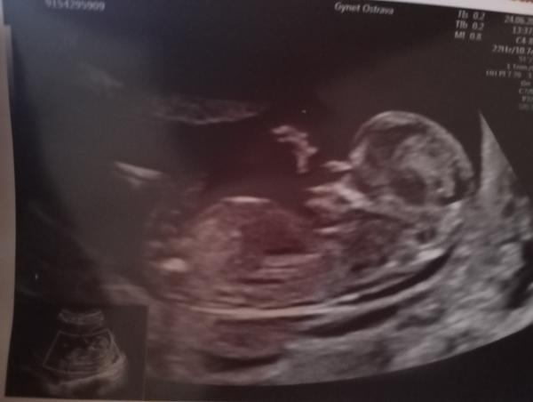 Změna příznaků těhotenství: Bude to dívka?