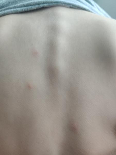 Pupínky u školkového dítěte. Co to může být?