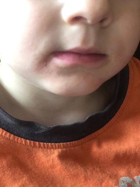 Vyrážka kolem úst. Můžete mi prosím poradit, co s tím?